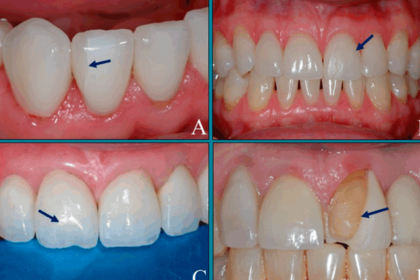 cosmetic-dentist-compares-the-top-3-veneer-materials