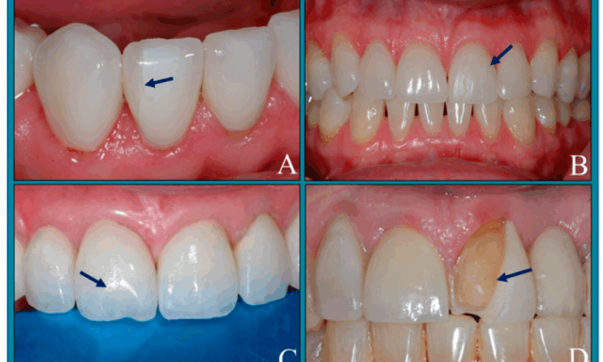 cosmetic-dentist-compares-the-top-3-veneer-materials